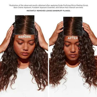 Before-and-after results of using Symbiose Routine for dandruff, showing significantly reduced flakes on the scalp.