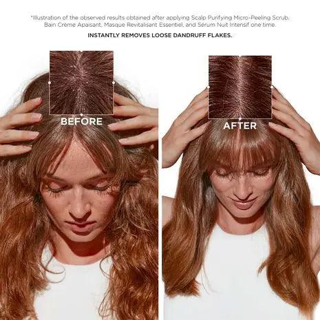 Before and after comparison showing effective removal of dandruff flakes from medium to thick hair using Symbiose Routine.